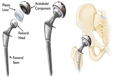 Revision Hip Replacement India, Best Hospital for Revision Hip Replacement Surgery in India, Cost of Revision Hip Surgery in India, Best Hip Replacement Surgeon in Gurgaon India.