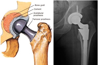 Revision Hip Replacement India, Best Hospital for Revision Hip Replacement Surgery in India, Cost of Revision Hip Surgery in India, Best Hip Replacement Surgeon in Gurgaon India.